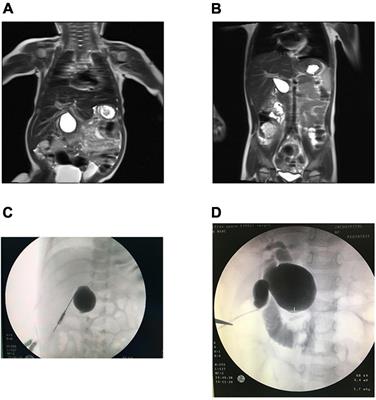 Comparative analysis of cystic biliary atresia and choledochal cysts